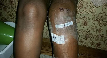 Jeena’s left leg 4 days post surgery with bandages and surgical marking BIX