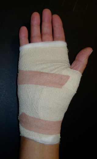 Hand bandaged around palm, fingers and thumb.