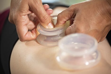 cupping technique being administered to a patient